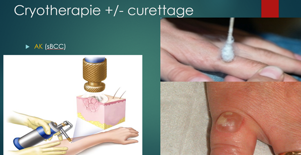 Dermatologie cryotherapie