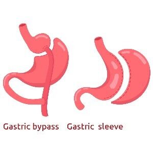 Gastricbypass gastricsleeve
