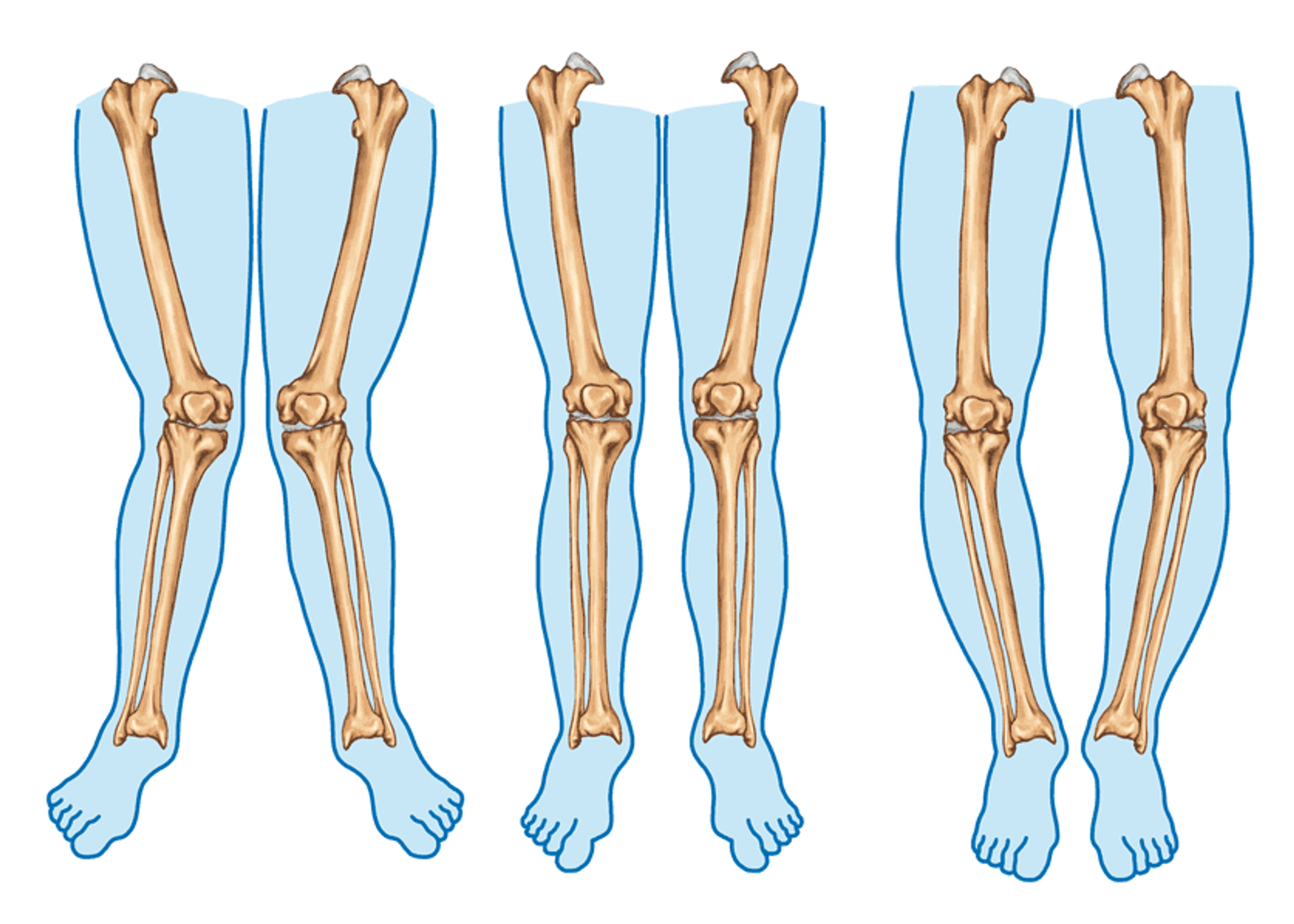 Osteotomie tekening